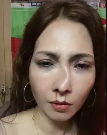 Người phụ nữ đăng đàn tố bị chồng đánh ‘tòe mũi’ mới nâng và sự thật khiến dân mạng bực mình